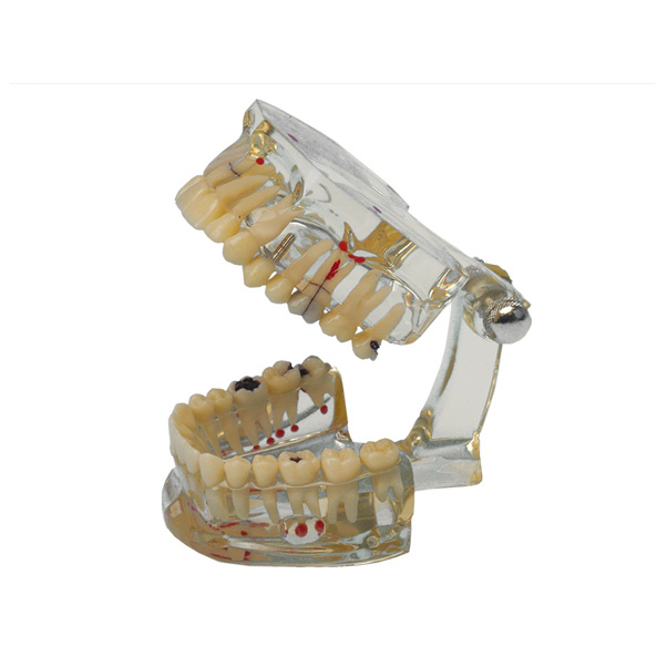 MODELE D ETUDE DENTS MALADES